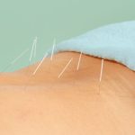 Acupuncture May Ease Chronic Low Back Pain Better Than Drugs