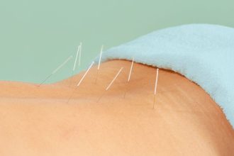Acupuncture May Ease Chronic Low Back Pain Better Than Drugs