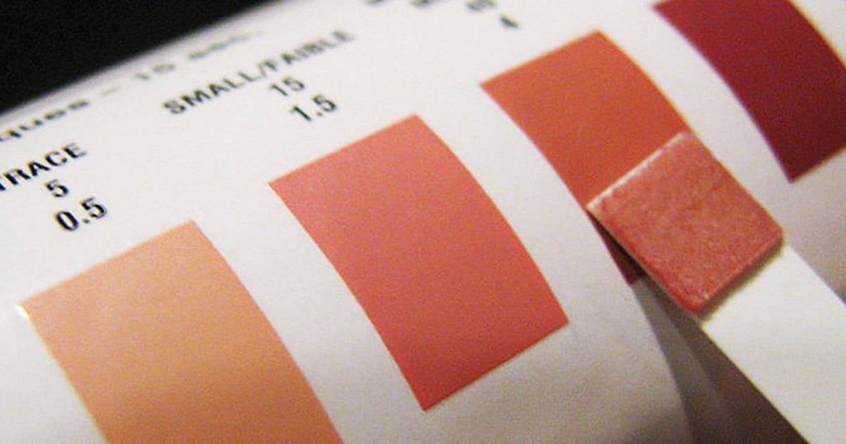 Ketosis Vs. Ketoacidosis: The Differences Explained