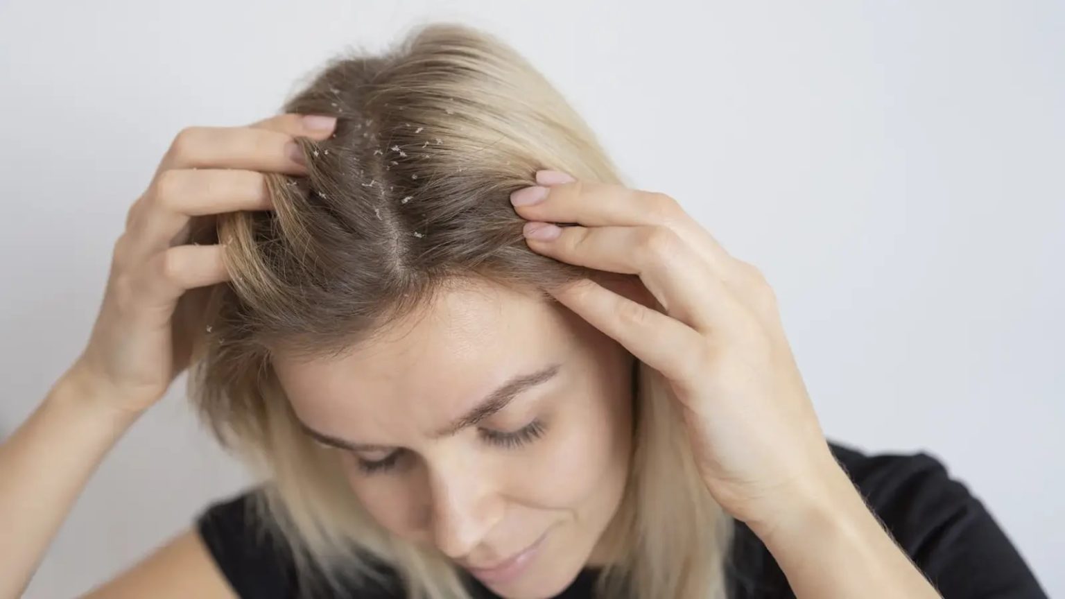 Tired of oily and sticky dandruff? Here are 6 quick fixes you need