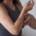 How colloidal oatmeal and ceramides can beat eczema? A dermatologist answers