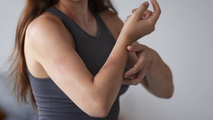 How colloidal oatmeal and ceramides can beat eczema? A dermatologist answers