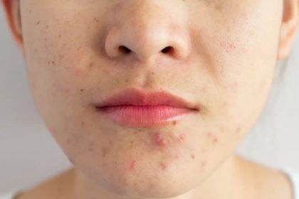 5 skincare hacks to fight acne when the season changes