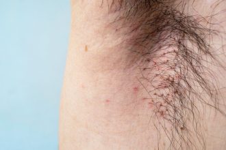 Everything You Need to Know About Body Lice, Including Symptoms and Treatments