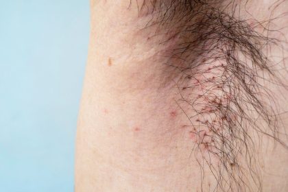 Everything You Need to Know About Body Lice, Including Symptoms and Treatments