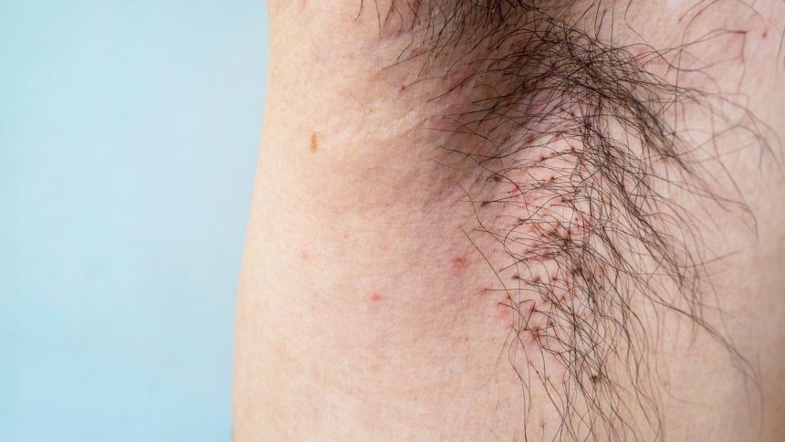 Everything You Need to Know About Body Lice, Including Symptoms and Treatments