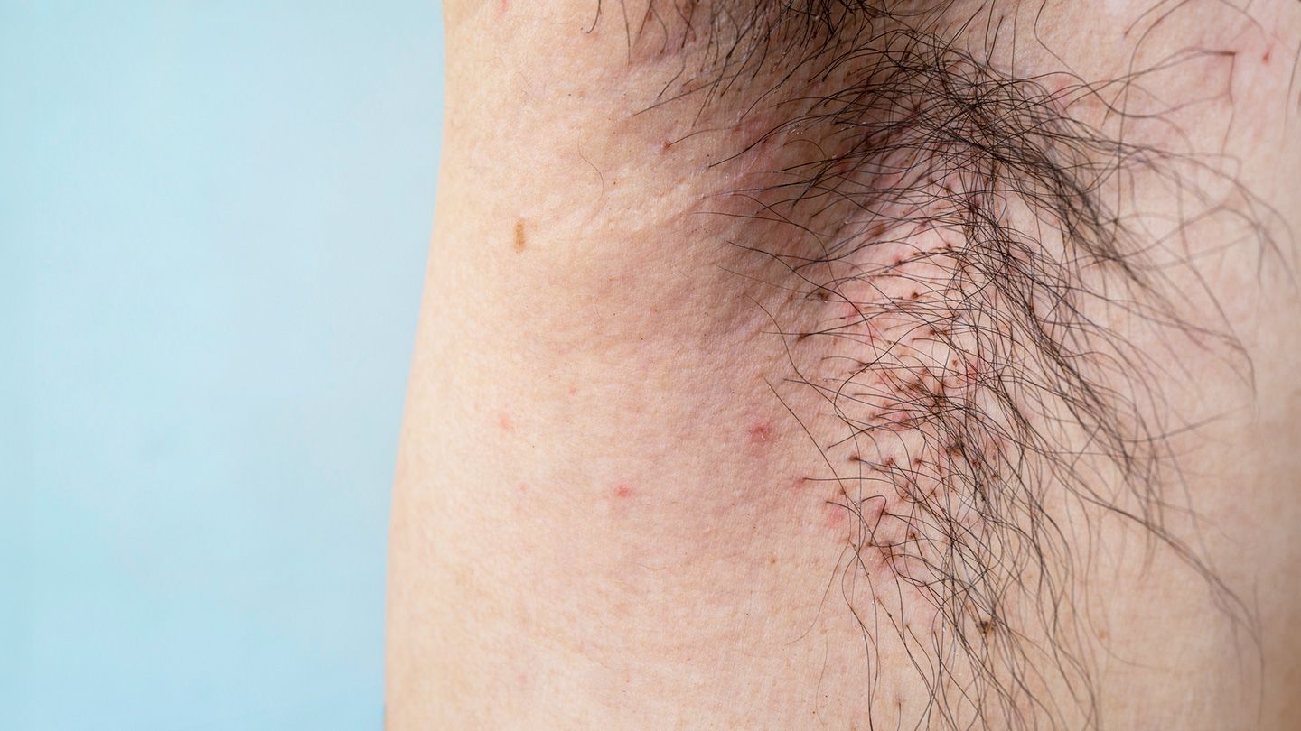 Everything You Need to Know About Body Lice, Including Symptoms and Treatments