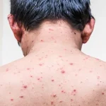 Chickenpox in Adults: Risk Factors, Symptoms, Complications, Treatment