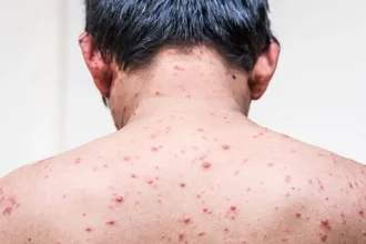 Chickenpox in Adults: Risk Factors, Symptoms, Complications, Treatment