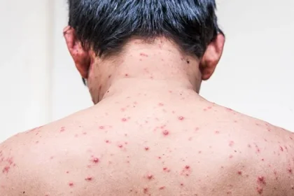 Chickenpox in Adults: Risk Factors, Symptoms, Complications, Treatment