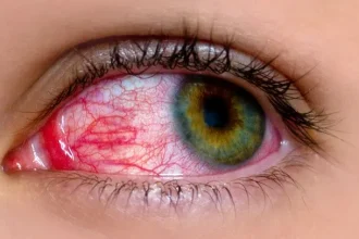 8 Common Myths About Pink Eye