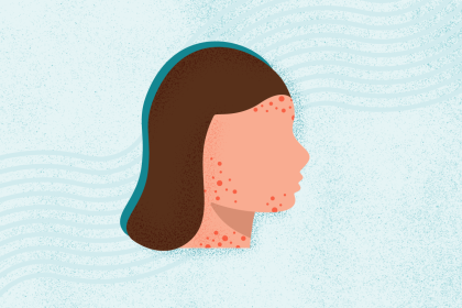 What Is Measles?