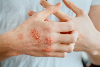 Is Your Atopic Dermatitis Well-Controlled? 3 Red Flags You Should Watch For