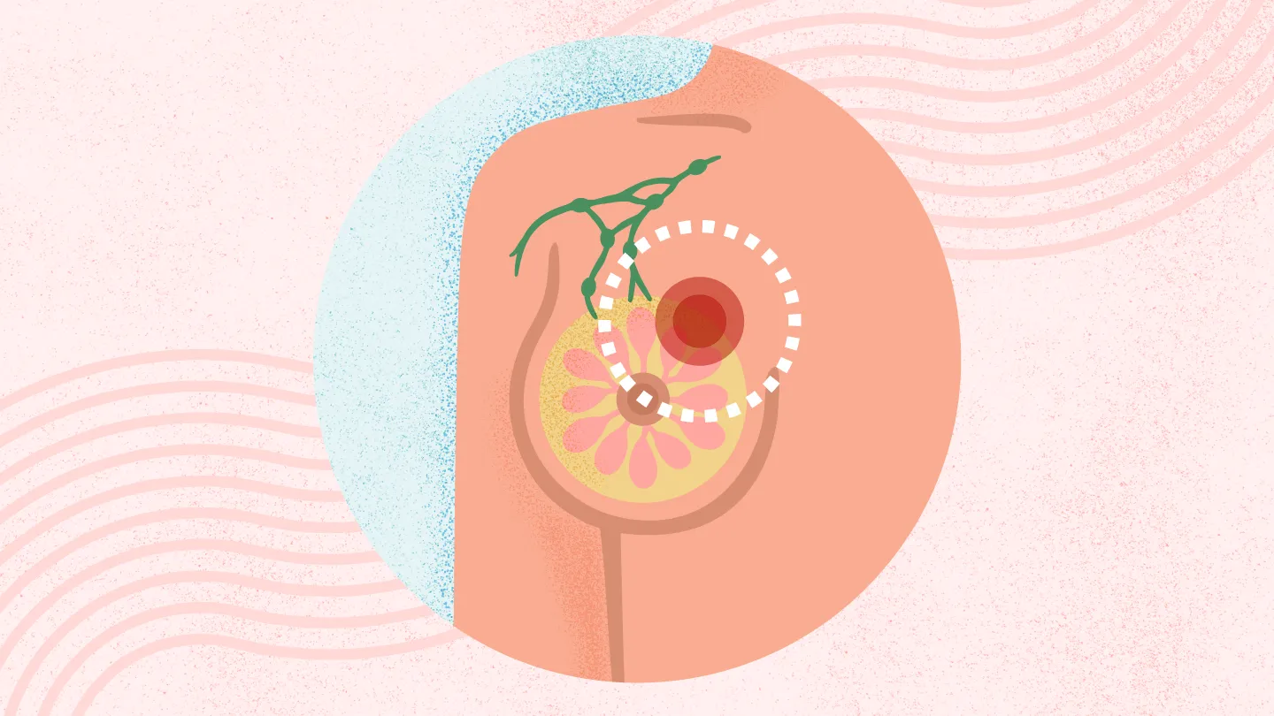 What Is Breast Cancer? Symptoms, Causes, Diagnosis, Treatment, and Prevention