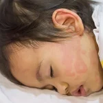 How to Manage Hives in Kids