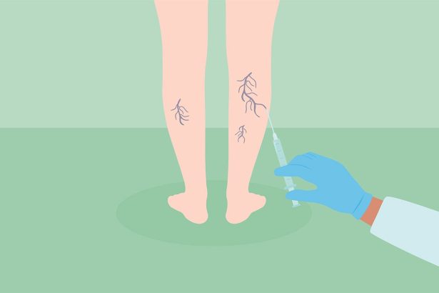 What Is Sclerotherapy for Spider Veins and Varicose Veins?